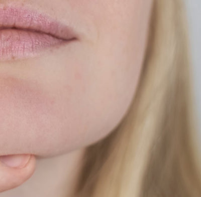 After - Dry, Dehydrated Skin2