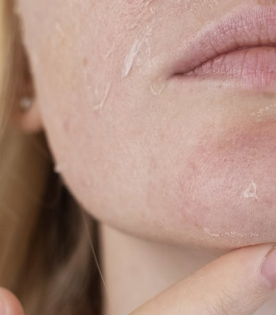 Before - Dry, Dehydrated Skin2