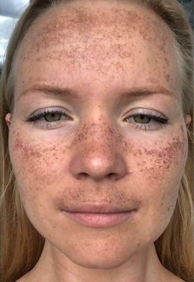 Before - Stubborn Dark Spots1