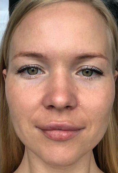 After - Stubborn Dark Spots1