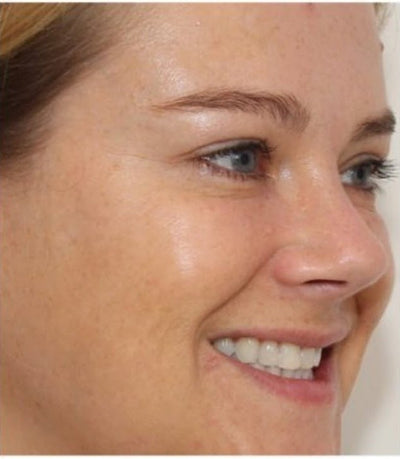 After - Fine Lines Appearing Early3
