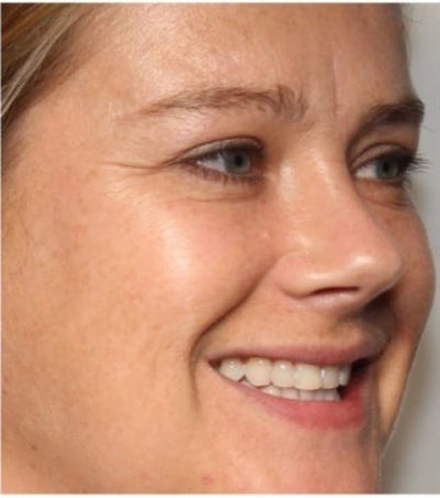 Before - Fine Lines Appearing Early3