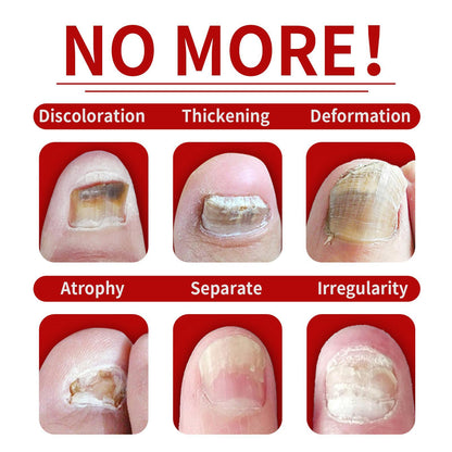 JAYSUING 7 Days Nail Fungus Treatment - All Plant Formula