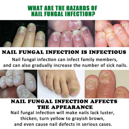 JAYSUING 7 Days Nail Fungus Treatment - All Plant Formula